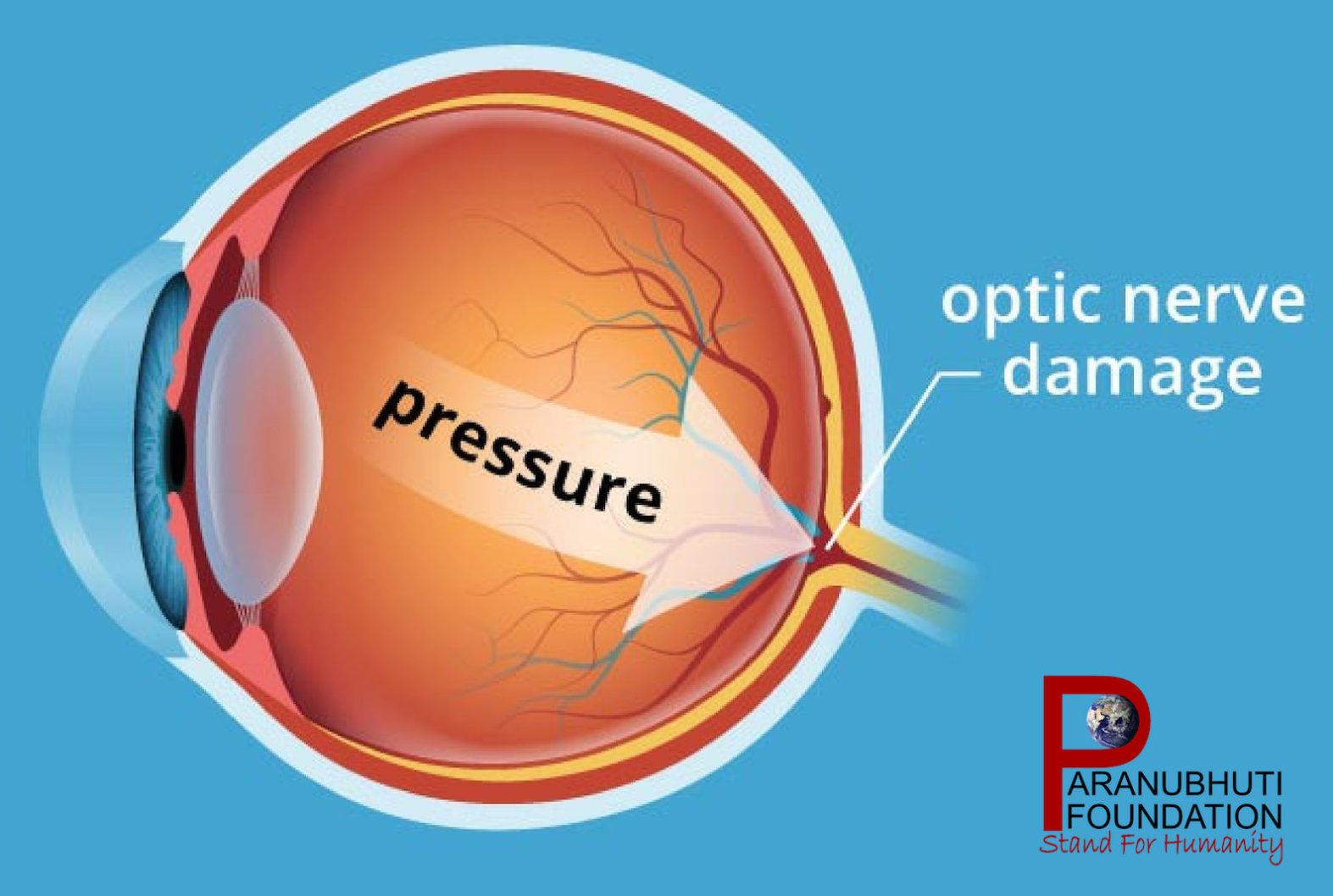 Как вылечить глаукому. Внутриглазное давление. Внутриглазное давление глаза. Глазное давление глаукома.